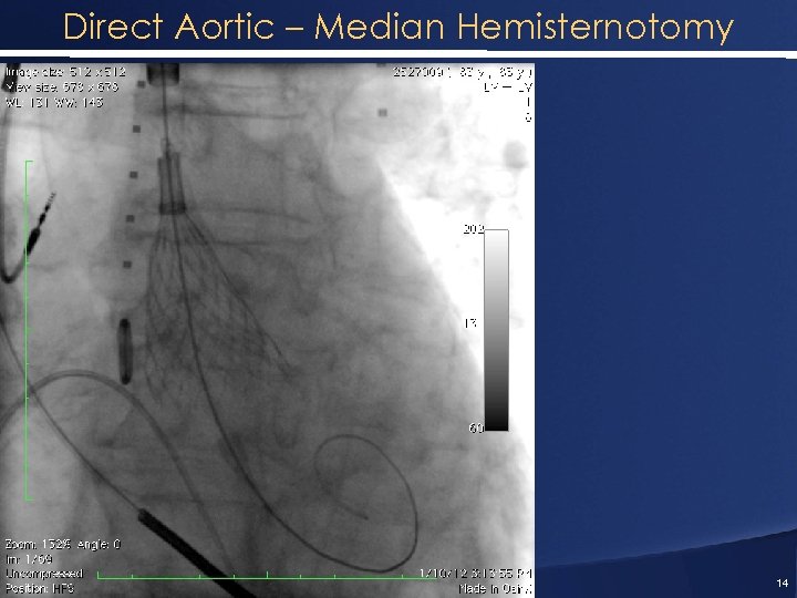 Direct Aortic – Median Hemisternotomy 14 