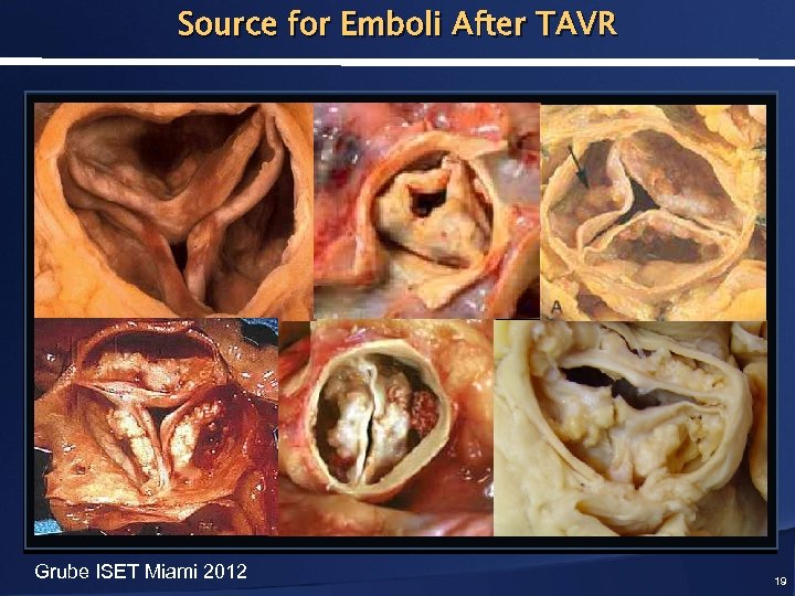 Source for Emboli After TAVR Grube ISET Miami 2012 19 