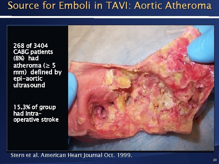 Source for Emboli in TAVI: Aortic Atheroma 268 of 3404 CABG patients (8%) had