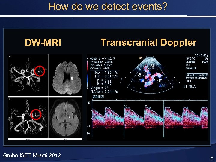 How do we detect events? DW-MRI Grube ISET Miami 2012 Transcranial Doppler 21 