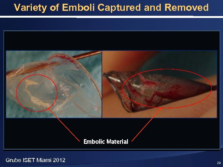 Variety of Emboli Captured and Removed Embolic Material Grube ISET Miami 2012 29 