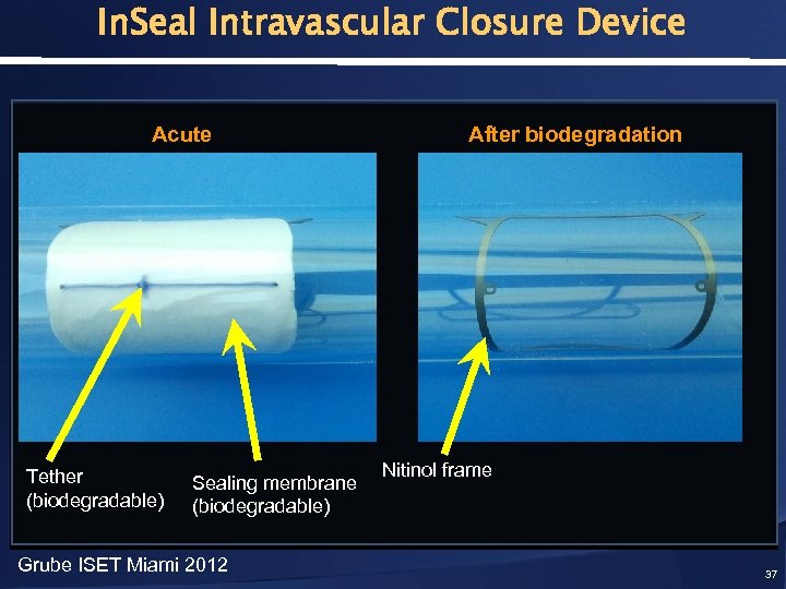 In. Seal Intravascular Closure Device Acute Tether (biodegradable) Sealing membrane (biodegradable) Grube ISET Miami