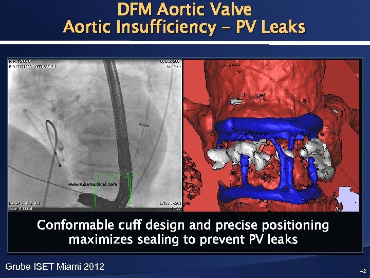 DFM Aortic Valve Aortic Insufficiency - PV Leaks Conformable cuff design and precise positioning