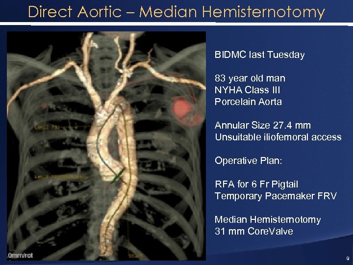 Direct Aortic – Median Hemisternotomy BIDMC last Tuesday 83 year old man NYHA Class