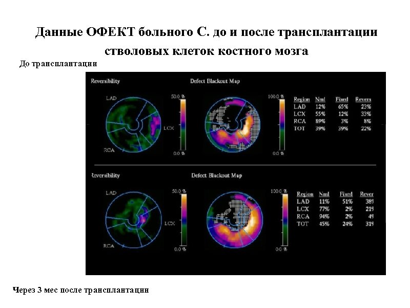 Данные ОФЕКТ больного С. до и после трансплантации стволовых клеток костного мозга До трансплантации