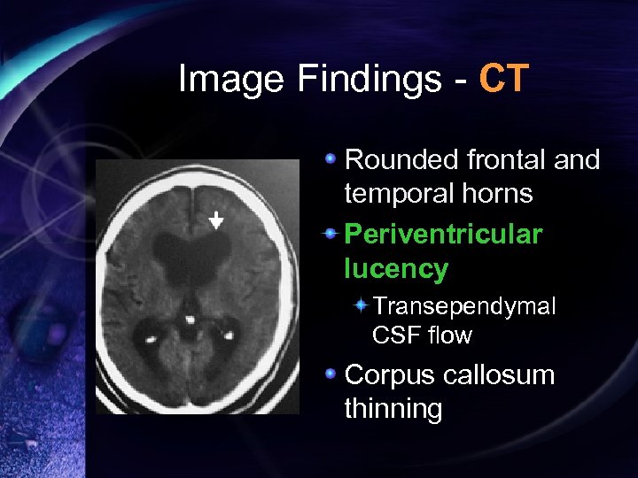 Image Findings - CT Rounded frontal and temporal horns Periventricular lucency Transependymal CSF flow