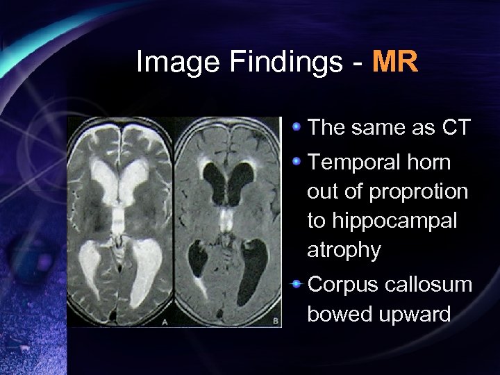 Image Findings - MR The same as CT Temporal horn out of proprotion to