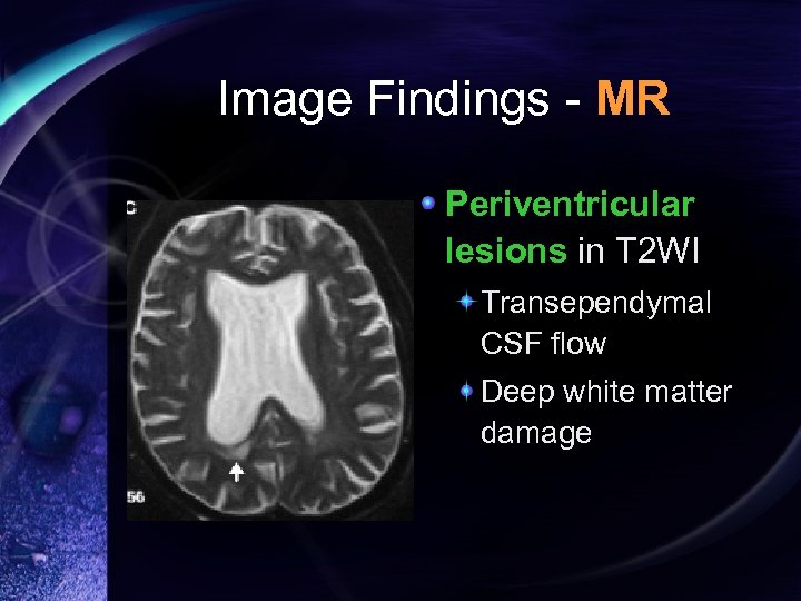 Image Findings - MR Periventricular lesions in T 2 WI Transependymal CSF flow Deep