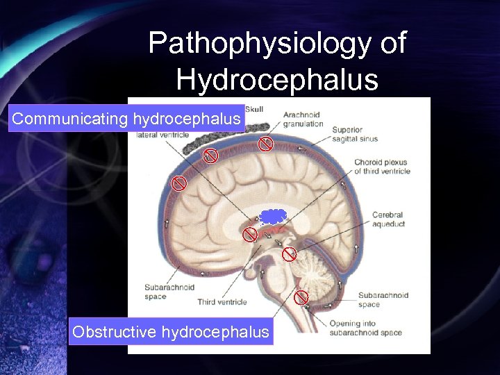 Pathophysiology of Hydrocephalus Communicating hydrocephalus Obstructive hydrocephalus 