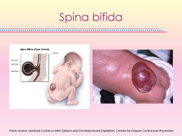 Spina bifida Photo source: National Center on Birth Defects and Developmental Disabilities, Centers for