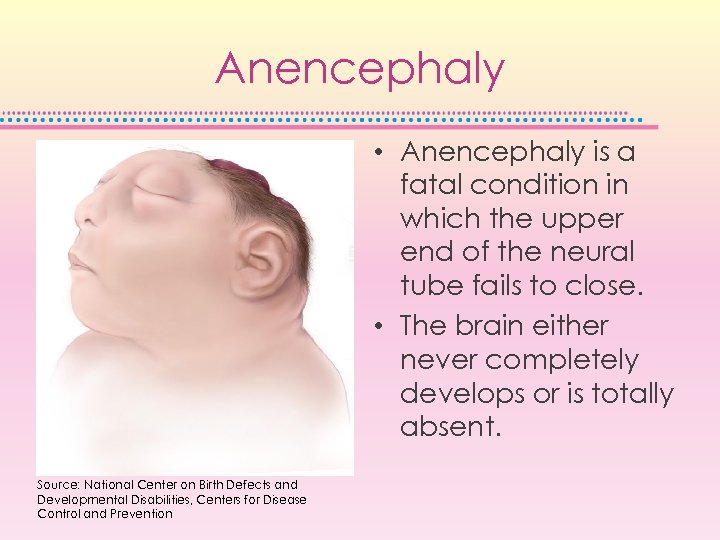 Anencephaly • Anencephaly is a fatal condition in which the upper end of the