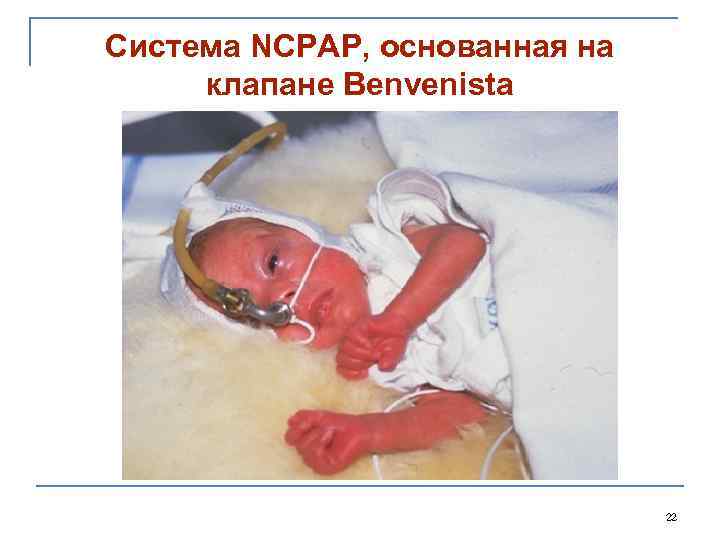 Система NCPAP, основанная на клапане Benvenista 22 