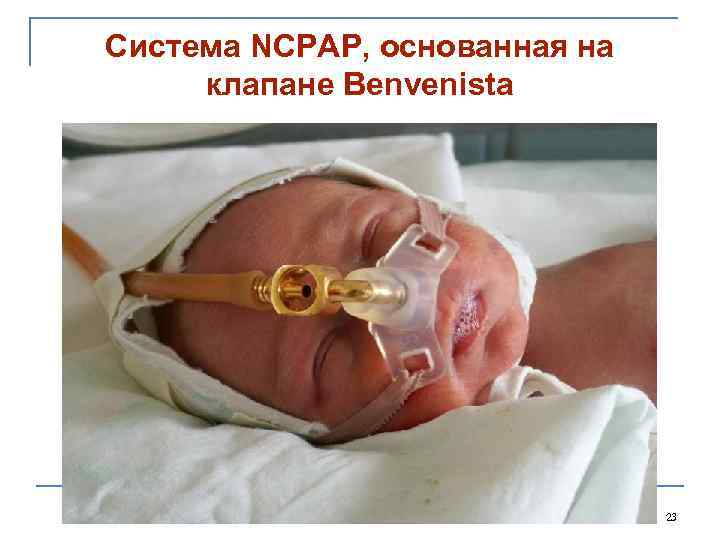 Система NCPAP, основанная на клапане Benvenista 23 
