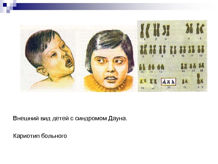 Внешний вид детей с синдромом Дауна. Кариотип больного 