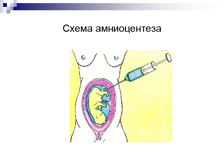 Схема амниоцентеза 