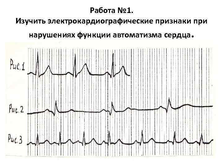 Работа № 1. Изучить электрокардиографические признаки при нарушениях функции автоматизма сердца. 