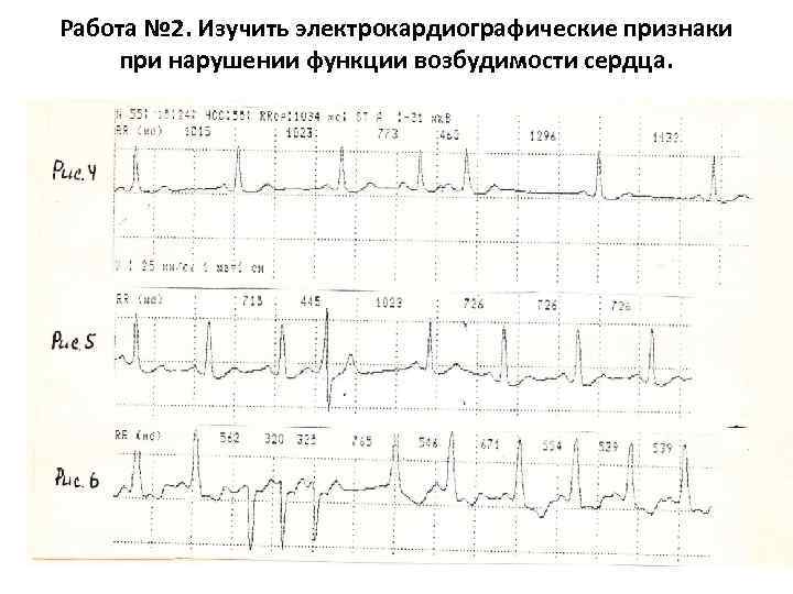 Работа № 2. Изучить электрокардиографические признаки при нарушении функции возбудимости сердца. 