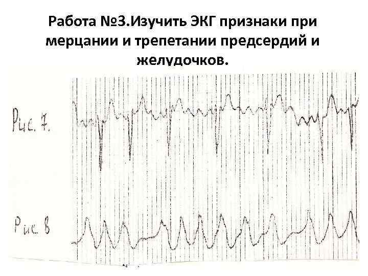 Работа № 3. Изучить ЭКГ признаки при мерцании и трепетании предсердий и желудочков. 
