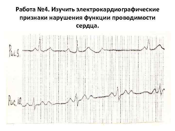 Работа № 4. Изучить электрокардиографические признаки нарушения функции проводимости сердца. 