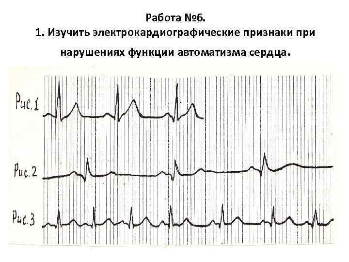 Работа № 6. 1. Изучить электрокардиографические признаки при нарушениях функции автоматизма сердца. 