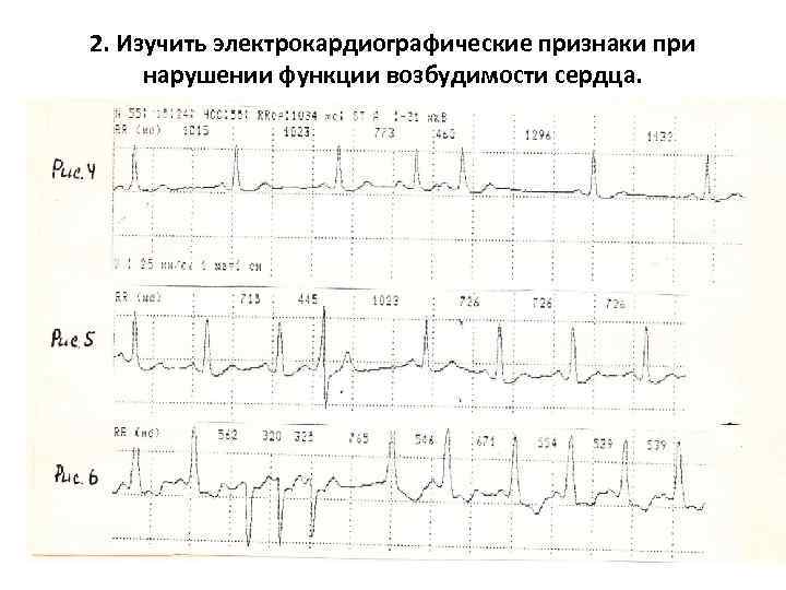 2. Изучить электрокардиографические признаки при нарушении функции возбудимости сердца. 