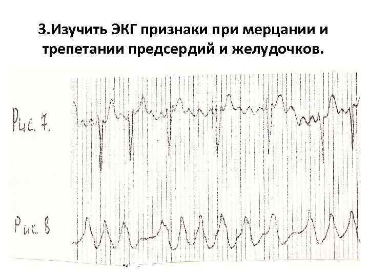 3. Изучить ЭКГ признаки при мерцании и трепетании предсердий и желудочков. 