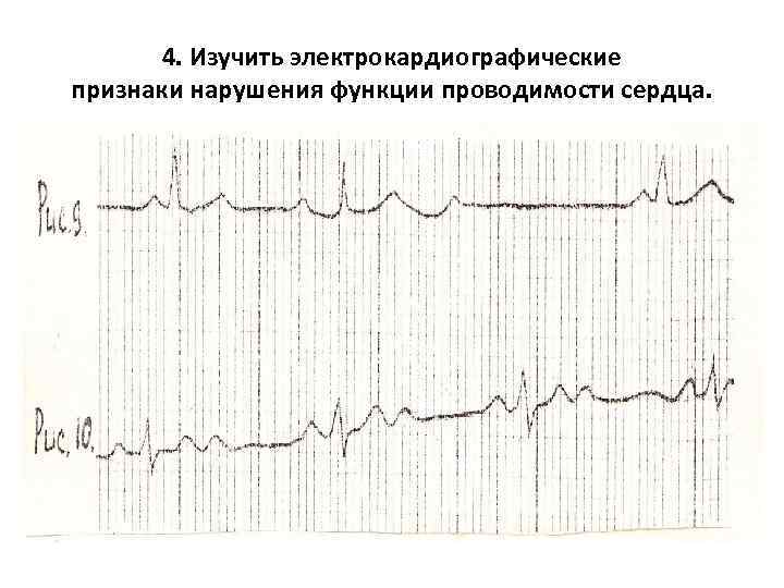 4. Изучить электрокардиографические признаки нарушения функции проводимости сердца. 