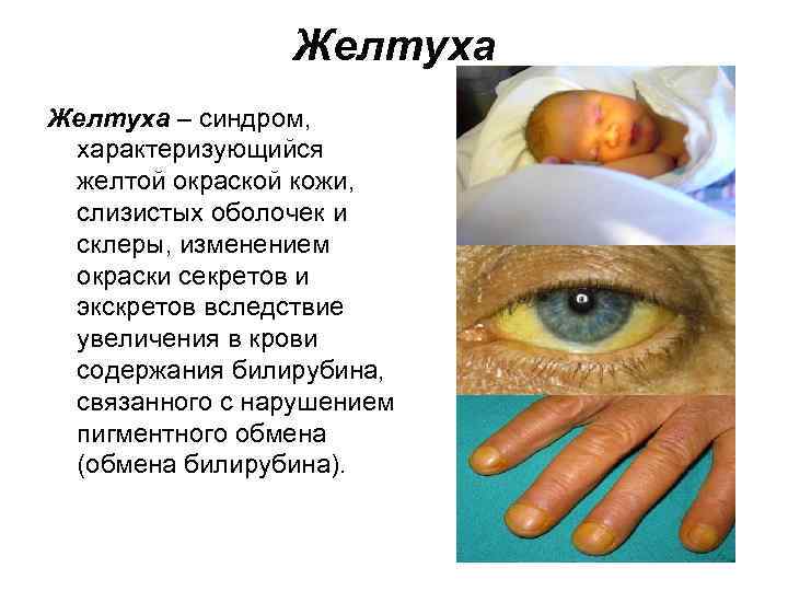 Желтуха – синдром, характеризующийся желтой окраской кожи, слизистых оболочек и склеры, изменением окраски секретов