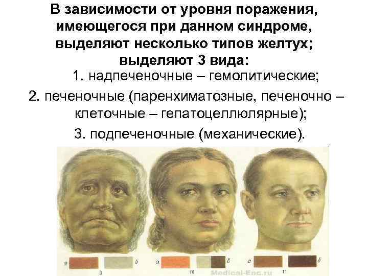 В зависимости от уровня поражения, имеющегося при данном синдроме, выделяют несколько типов желтух; выделяют