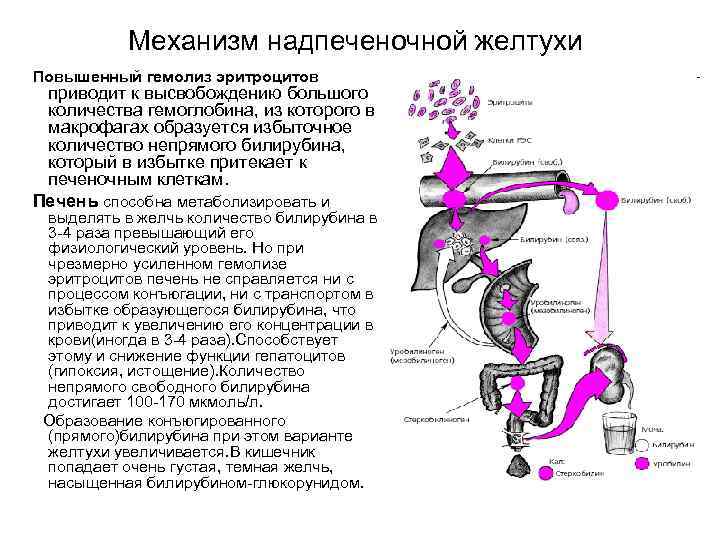Механизм надпеченочной желтухи Повышенный гемолиз эритроцитов приводит к высвобождению большого количества гемоглобина, из которого