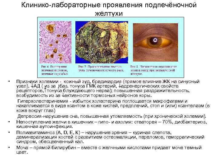 Клинико-лабораторные проявления подпечёночной желтухи • • Признаки холемии - кожный зуд, брадикардия (прямое влияние
