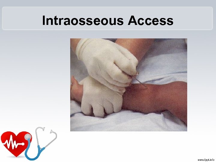 Intraosseous Access 