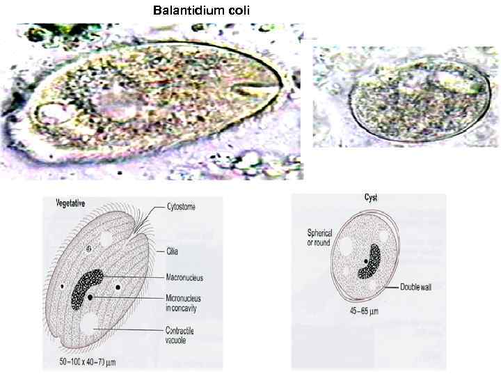 Balantidium coli 