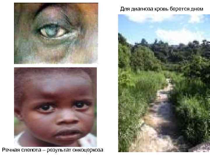 Для диагноза кровь берется днем Речная слепота – результат онкоцеркоза 
