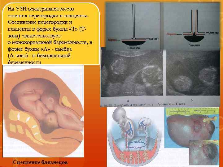 На УЗИ осматривают место слияния перегородки и плаценты. Соединение перегородки и плаценты в форме
