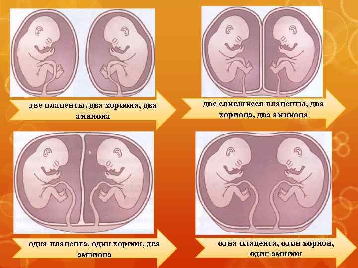 две плаценты, два хориона, два амниона одна плацента, один хорион, два амниона две слившиеся
