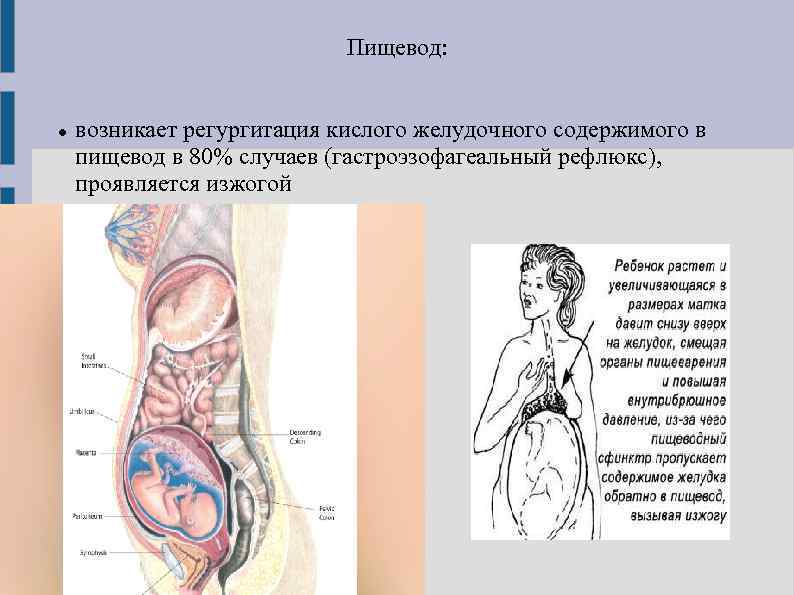 Пищевод: возникает регургитация кислого желудочного содержимого в пищевод в 80% случаев (гастроэзофагеальный рефлюкс), проявляется