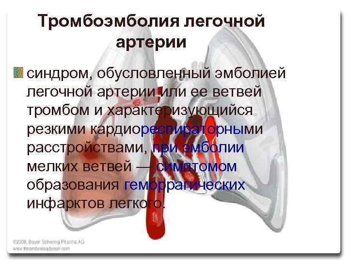 Тромбоэмболия легочной артерии синдром, обусловленный эмболией легочной артерии или ее ветвей тромбом и характеризующийся