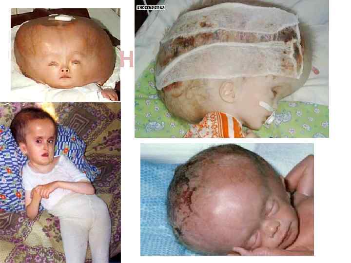 HYDROCEPHALY 