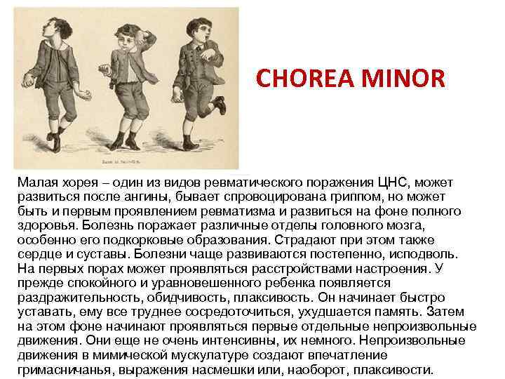 CHOREA MINOR Малая хорея один из видов ревматического поражения ЦНС, может развиться после ангины,