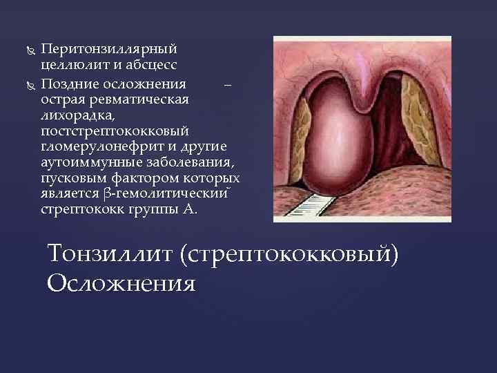  Перитонзиллярный целлюлит и абсцесс Поздние осложнения – острая ревматическая лихорадка, постстрептококковый гломерулонефрит и