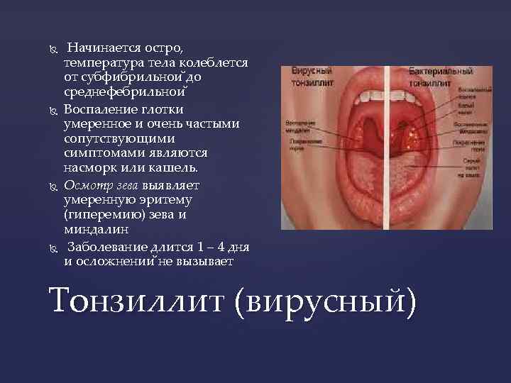  Начинается остро, температура тела колеблется от субфибрильнои до среднефебрильнои Воспаление глотки умеренное и