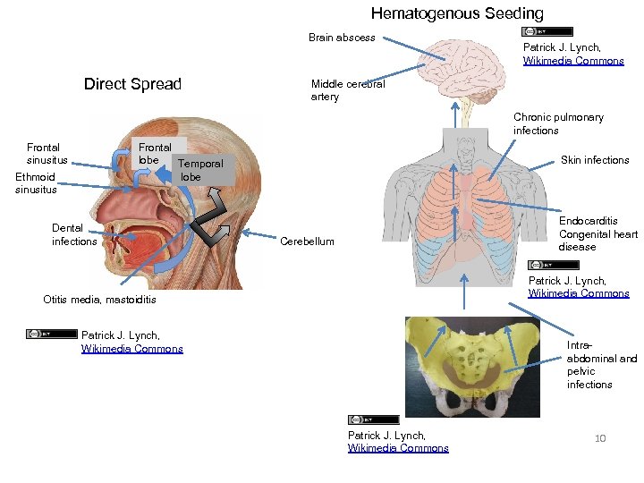 Hematogenous Seeding Brain abscess Direct Spread Patrick J. Lynch, Wikimedia Commons Middle cerebral artery