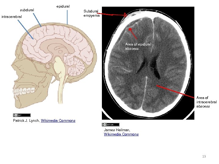 subdural epidural intracerebral Subdural empyema Area of epidural abscess Area of intracerebral abscess Patrick