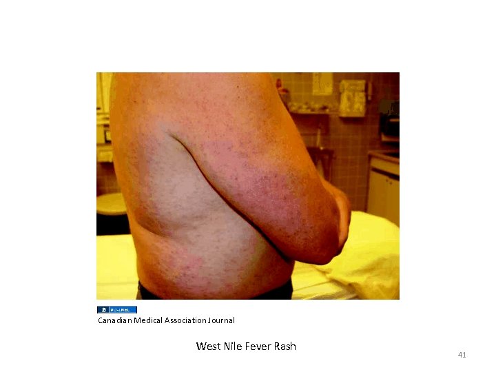 Canadian Medical Association Journal West Nile Fever Rash 41 