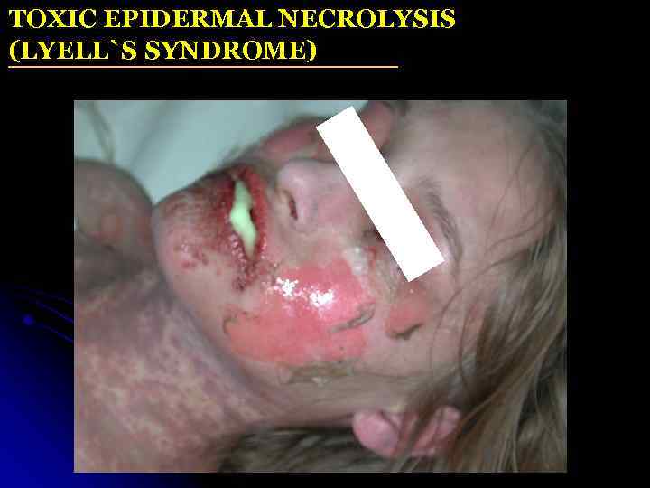 TOXIC EPIDERMAL NECROLYSIS (LYELL`S SYNDROME) 