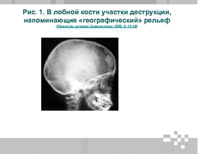 Рис. 1. В лобной кости участки деструкции, напоминающие «географический» рельеф (Новости лучевой диагностики 1998