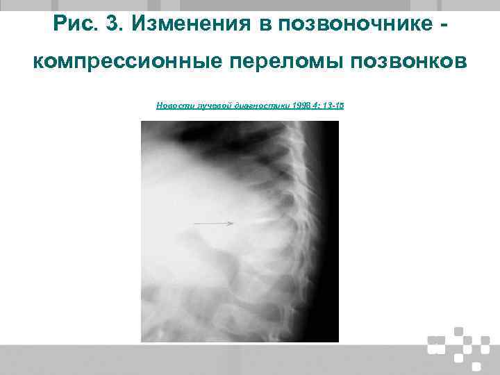Рис. 3. Изменения в позвоночнике компрессионные переломы позвонков Новости лучевой диагностики 1998 4: 13