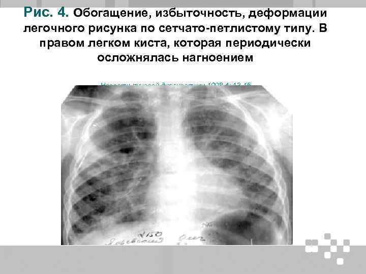 Что такое деформация легочного рисунка