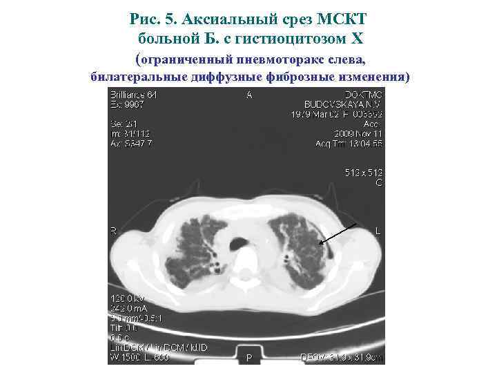 Рис. 5. Аксиальный срез МСКТ больной Б. с гистиоцитозом Х (ограниченный пневмоторакс слева, билатеральные